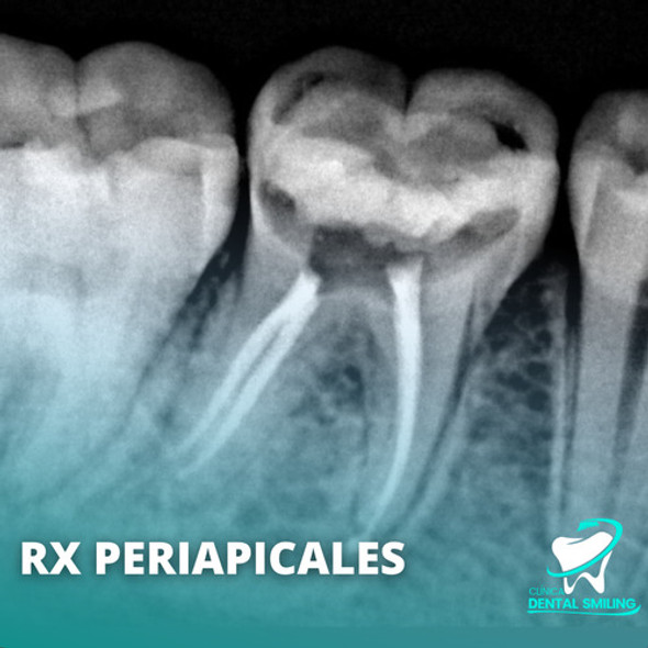 Rx Periapical 1 Rx Periapical 1