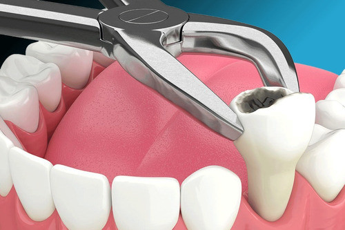 Extracciones Dentales. Once 0