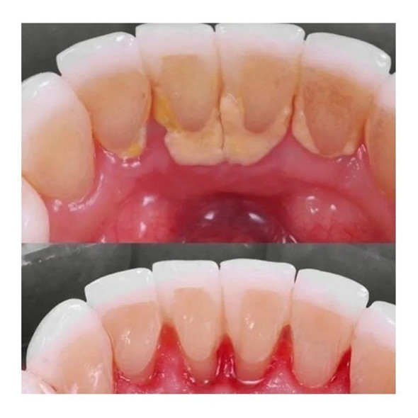 Limpieza Dental Profunda /tartrectomia Sarro Marmen Odontol. 0