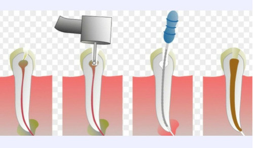 Tratamiento De Conducto Multirradicular  Molares 1