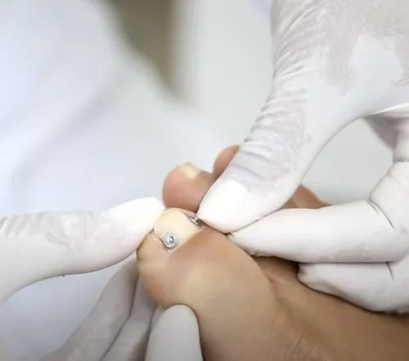 Kit Estético Botão + Elástico P/ Desencravar Unhas 1