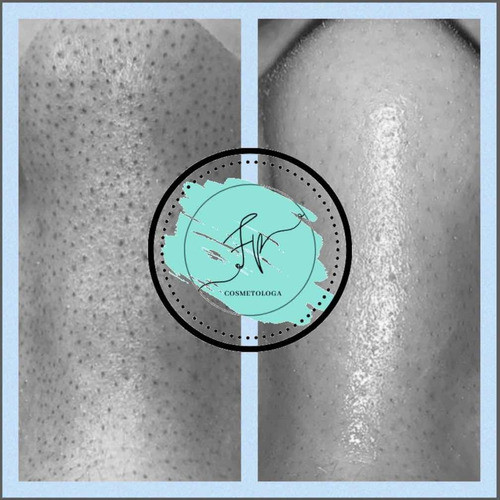 Limpieza De Cutis Profunda Con Puntas De Diamante 1