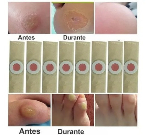 20 Banditas P Callos Acido Removedor Verrugas Ojo Gallo 0