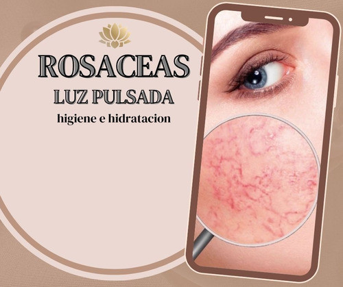 Rosaceas Con Luz Pulsada Intensa (caballito) 0