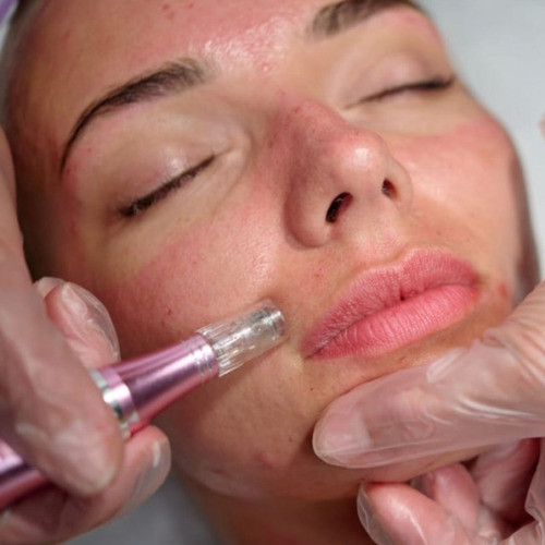 Caneta Dermapen Para Microagulhamento Regeneração De Pele 1