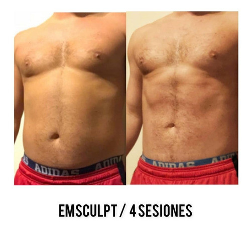 Tonifación Muscular Y Quema Grasa Bodysculpting 10 Sesiones 1