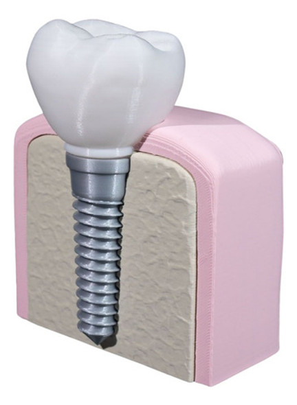 Ferramenta De Treinamento Em Odontologia Modelo De Implante 1