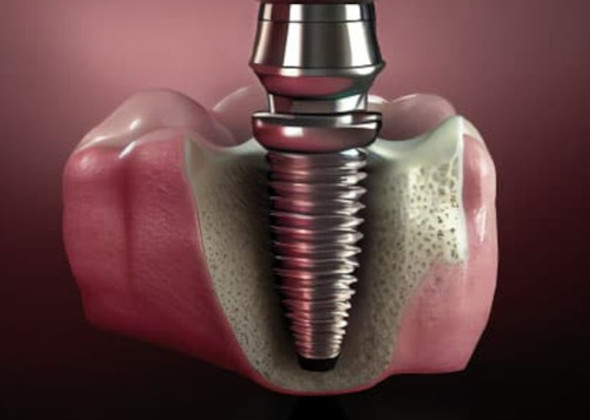 Implante Dental  Sin Corona Zona Sur Gba Con Garantia 0 Implante Dental  Sin Corona Zona Sur Gba Con Garantia 0