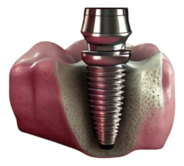 Implante Dental  Sin Corona Zona Sur Gba Con Garantia 0 Implante Dental  Sin Corona Zona Sur Gba Con Garantia 0