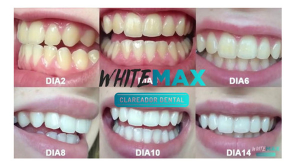 2 Clareamento Dental Melhor Mercado Livre Seguro Eficaz 1