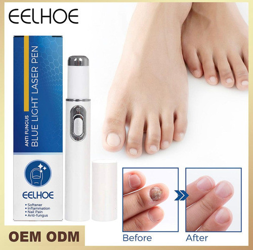 Laser Pen - Azul - Antihongos - Bactericida - Onicomicosis 1