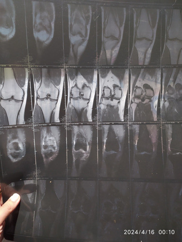 Placas Radiográficas Usadas Y Resonancias 0