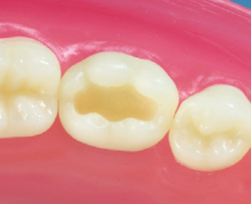 Dente Pronew 36.1 Dm Classe I Na Face Oclusal 0