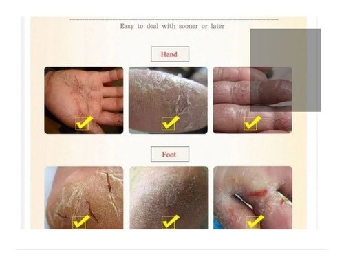 Para Curar Pés Rachados E Mãos Ressecados Ultra Hidratante 1