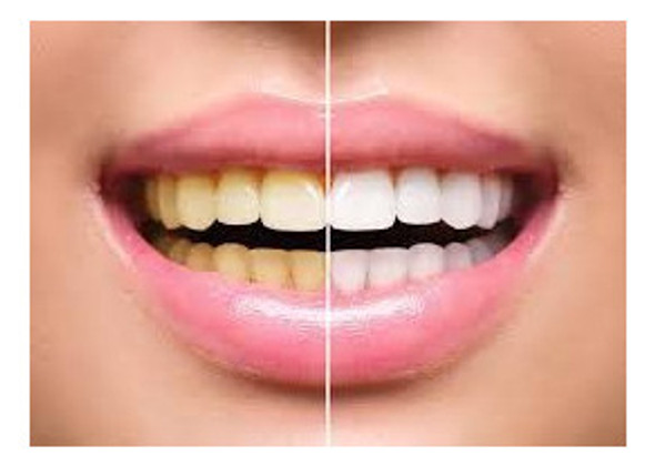 2 Clareador Dental Caseiro Dental Valor 2019 Tv 1