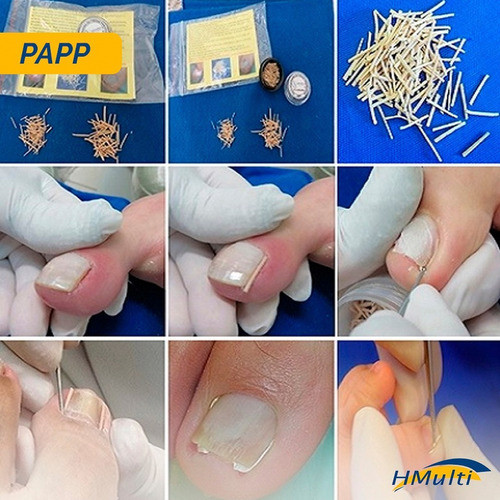 Kit 6-papp Pasta Afastadora De Pregas Periungueais Podologia 1