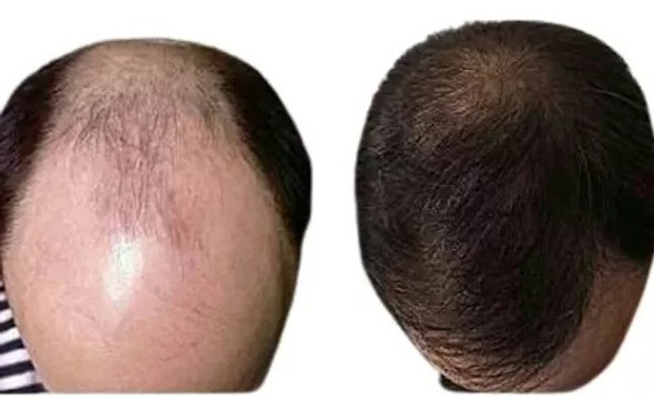 Anticaida Capilar Creciemiento Barba  Rinde 500 Gotas 0 Anticaida Capilar Creciemiento Barba  Rinde 500 Gotas 0