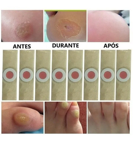 24 Adesivos Removedor De Calos, Verrugas, Olho De Peixe* 1