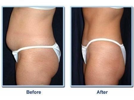 Ultracavitacion Y Radiofrecuencia O Masaje Reductor 1