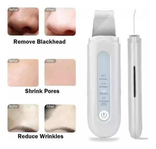 Esfoliador De Pele Poro Ultrassonico Para Limpeza Facial 1