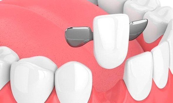 Prótesis Dental /no Arañita /puente Fijo 0