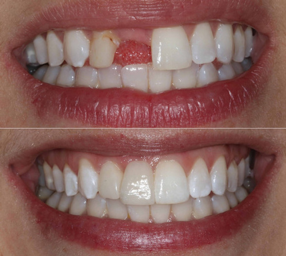 Prótesis Dental /no Arañita /puente Fijo 1