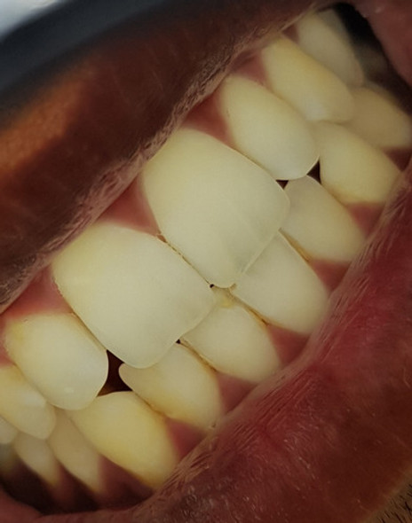 Lente Polarizador Para Movil Quita El Brillo Para Dental 1
