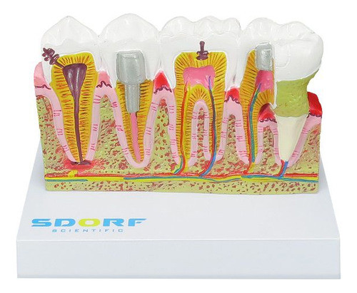 Modelo De Patologias Dentárias 0