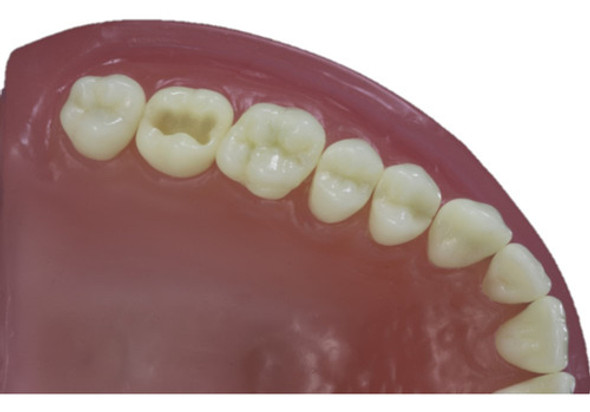 Dente Pronew 17.1 Dm - Classe I Na Face Oclusal 0