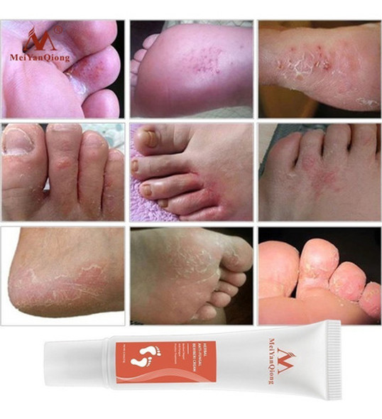 Fitoterapia Creme Para Os Pés Remédio Para Fungos Beleza Saú 1