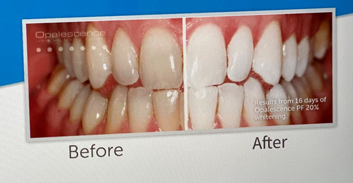 Opalescence 15% Pf / Blanqueamiento / 2 Jeringas 1