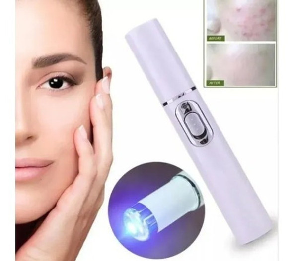 Lápiz Láser Portátil  45nm  Varizes Acne Manchas Cicatrices 1 Lápiz Láser Portátil  45nm  Varizes Acne Manchas Cicatrices 1