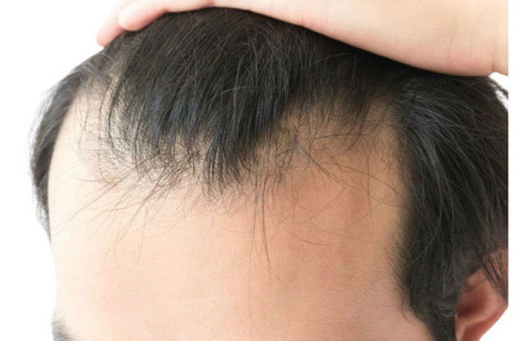 Tratamiento Para Caída De Cabello (mesoterapia) 0