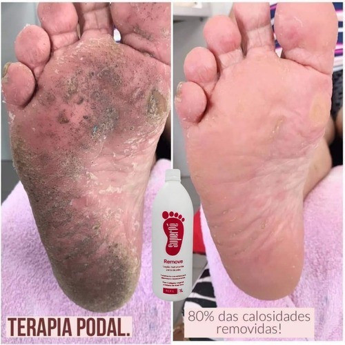 Remove Super Pé 220ml+ Espatula 222 + Esfoliante Scrub 220ml 1