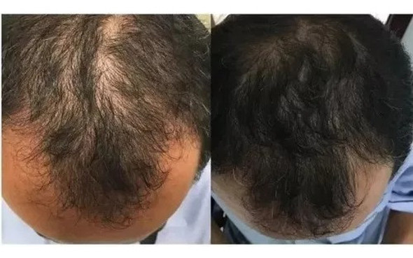 Tratamiento Para Crecimiento Cabello Barba Cejas Originales 1