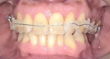 Ortodoncia Con Brackets Estéticos En Cuotas Sin Interés!!! 0