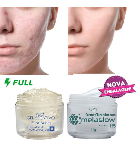 Kit Gel Secativo Acnes + Clareador Facial Marcas De Espinhas 0
