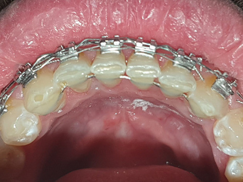 Contención Fija / Retenedor Post Ortodoncia. 1