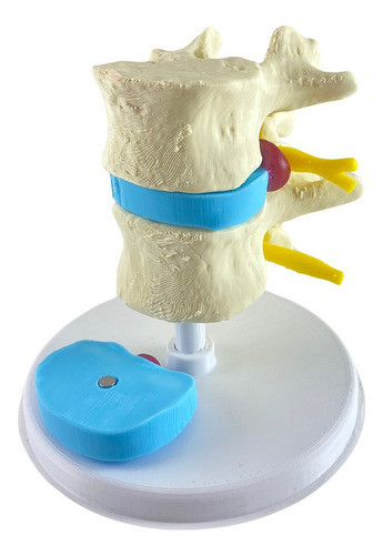 Maqueta Hernia De Disco - 3d 0