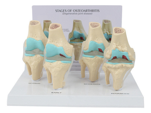 Kit De Joelho: Modelo De Anatomia De Osteoartrite Com Chave 0