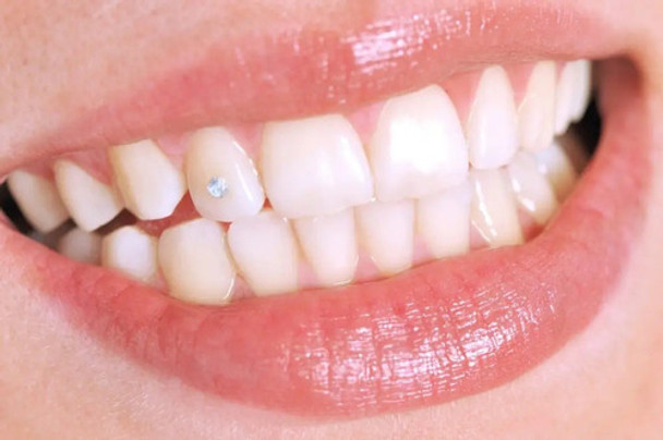 Colocacion Joyeria Dental  Crystales A Domicilio O Gabinete 0 Colocacion Joyeria Dental  Crystales A Domicilio O Gabinete 0