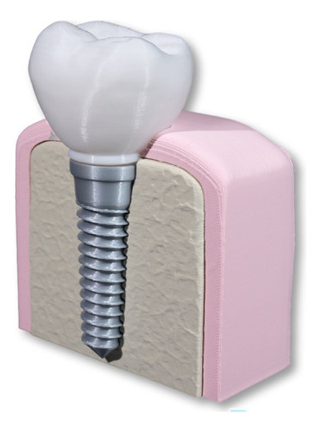 Maqueta Implante Molar Didáctico Paciente Impresión 3d 0