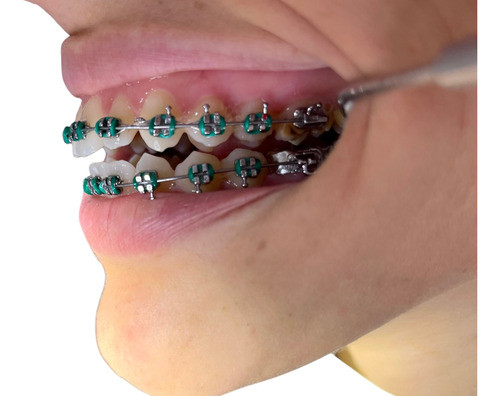 Instalación De Brackets Metálicos - Ortodoncia Metálica 0