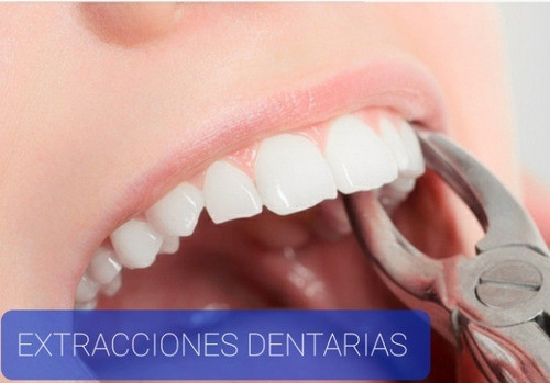 Extracción Dental Simple 0