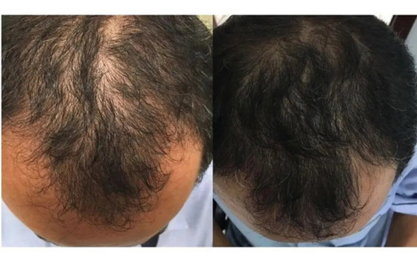 Tratamiento Para Crecimiento Del Cabello - Barba 0 Tratamiento Para Crecimiento Del Cabello - Barba 0
