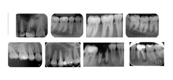 Radiografia Periapical Microcentro Marmen Odontologia 0