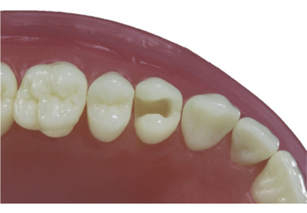 Dente Pronew 14 Dentistica 0