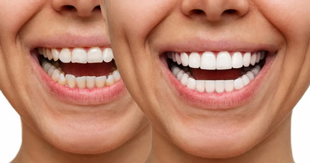 Carilla Dental De Resina Consultorio Odontologico Marmen 0
