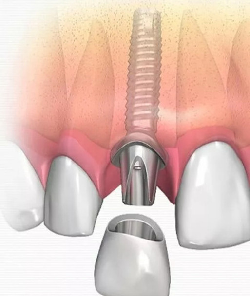 Implante Dental Sin Corona 0 Implante Dental Sin Corona 0