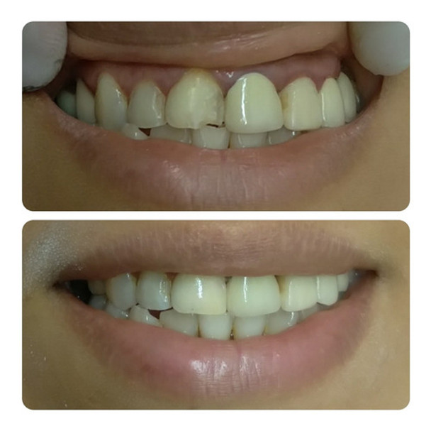 Corona Provisoria Dental Acetato C/u 0